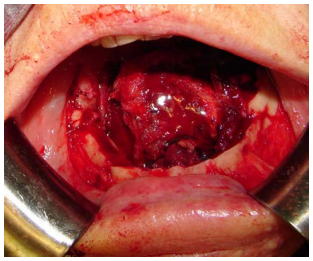 reconstruction figure total glossectomy tongue cancer chapter